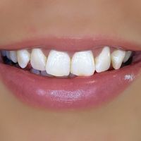 Composite Bonding - Smile 15 before